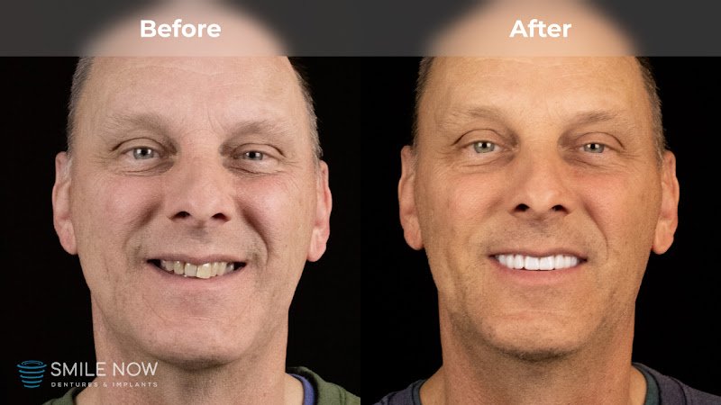 Smile Now Eugene Dentures and Implants
