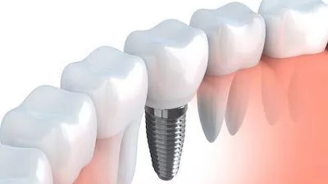 Dental implants provided by Tucson dentist Craycroft Prime Dental