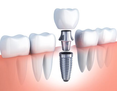row tooth and Dental implant
