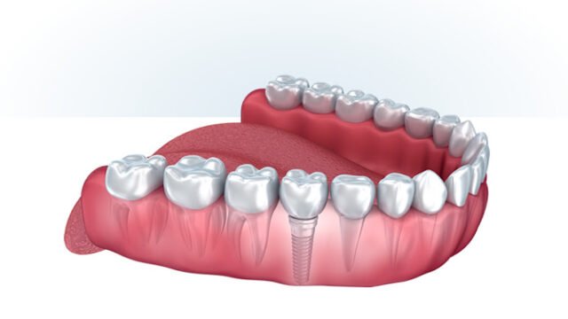 Ora Dental Implant Studio