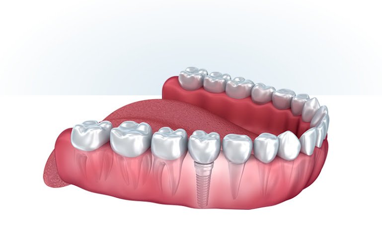 Ora Dental Implant Studio
