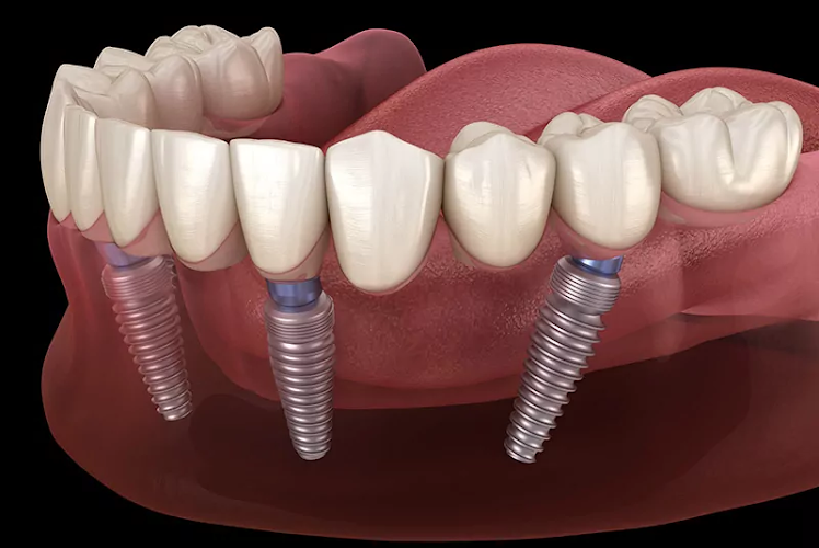 Dental Implants Phoenix