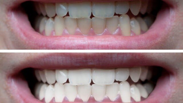 Closeup of woman’s teeth before and after whitening