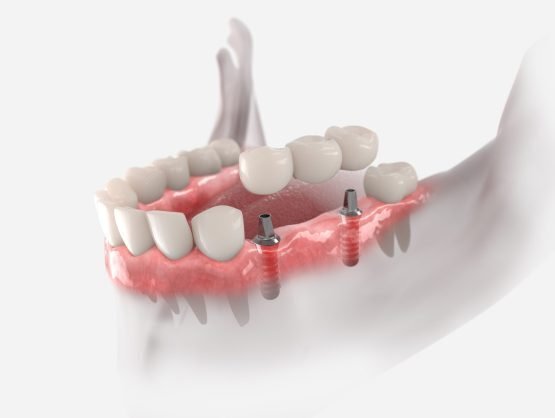 The Dental Implant Place