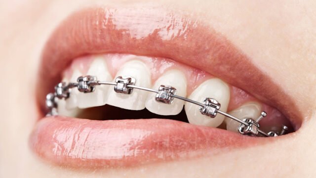 teeth with braces