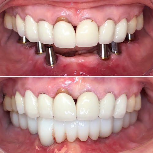 University Dental Implant Center