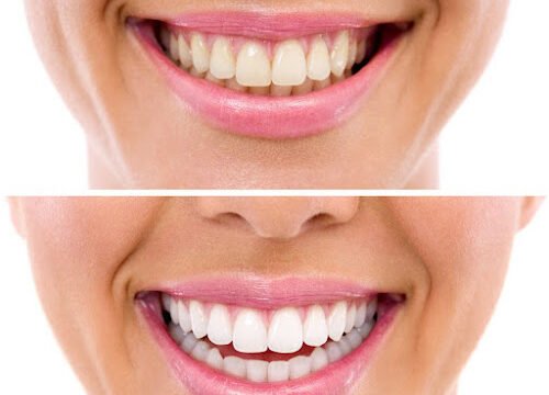 Best Cosmetic Dentist in Valley Village CA