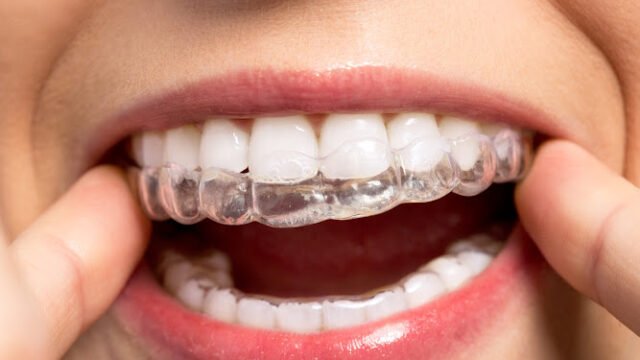 Invisalign Scottsdale – Divine Dental – Scottsdale Invisalign provider near Me