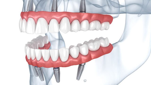 Prostheses supported by 8 implants. Dental 3D illustration