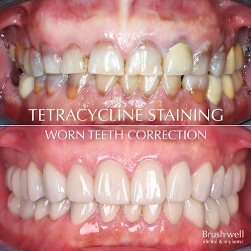 Brushwell Dental & Implants