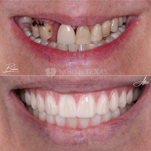 North Texas Dental Surgery Wisdom Teeth and Denture Implant Center