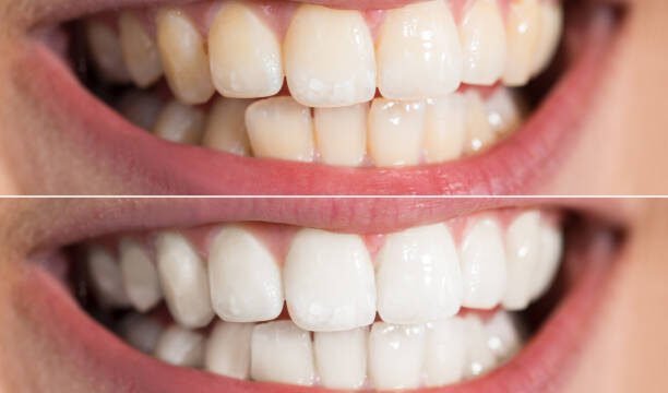 Close-up Detail Of Person Teeth Showing Before And After Whitening