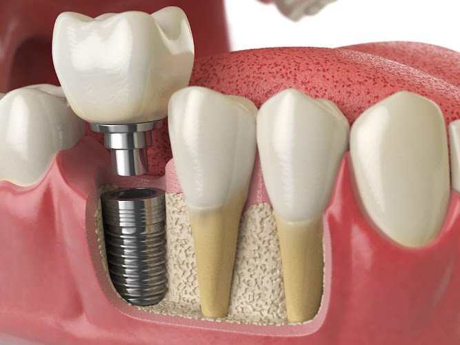 Brisman Implant and Oral Surgery