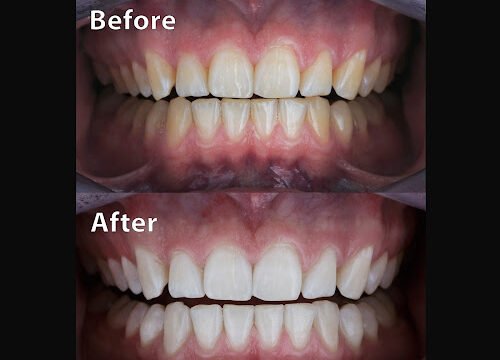 dental photo comparison before and after teeth whitening