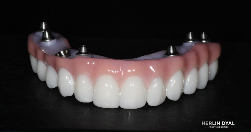 Herlin Dyal Prosthodontics, Dental Implants in Sacramento