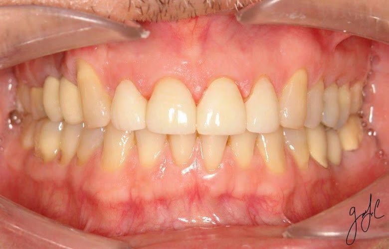 Dental Implants and Prosthodontics