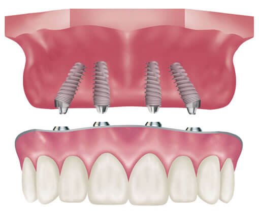 Partners Dentures and Implants