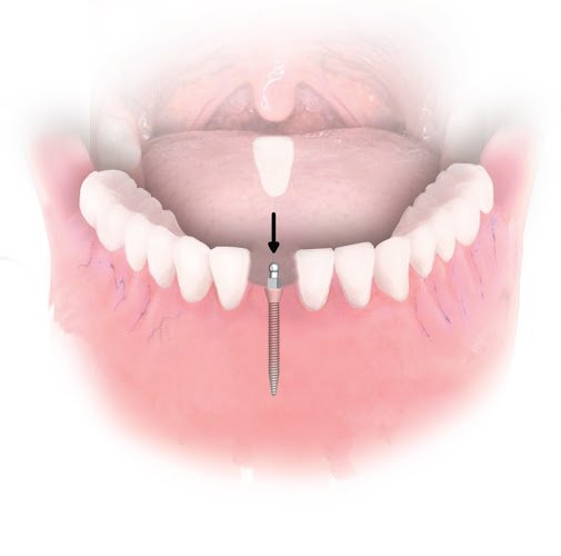 Dental Implant Solutions