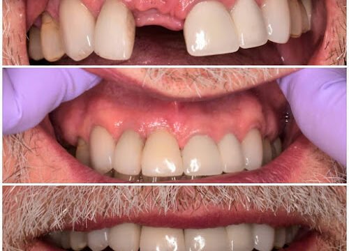 Dental Tooth Implant