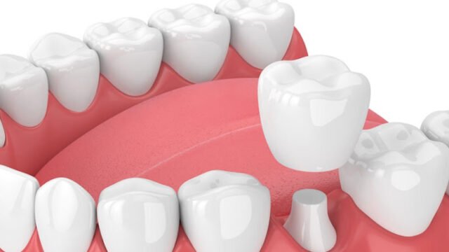 Dental Implants in Utah
